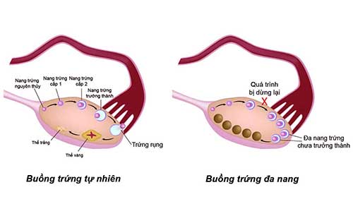 kinh nguyệt không đều là dấu hiệu nguyên nhân do buồng trứng bị đa nang